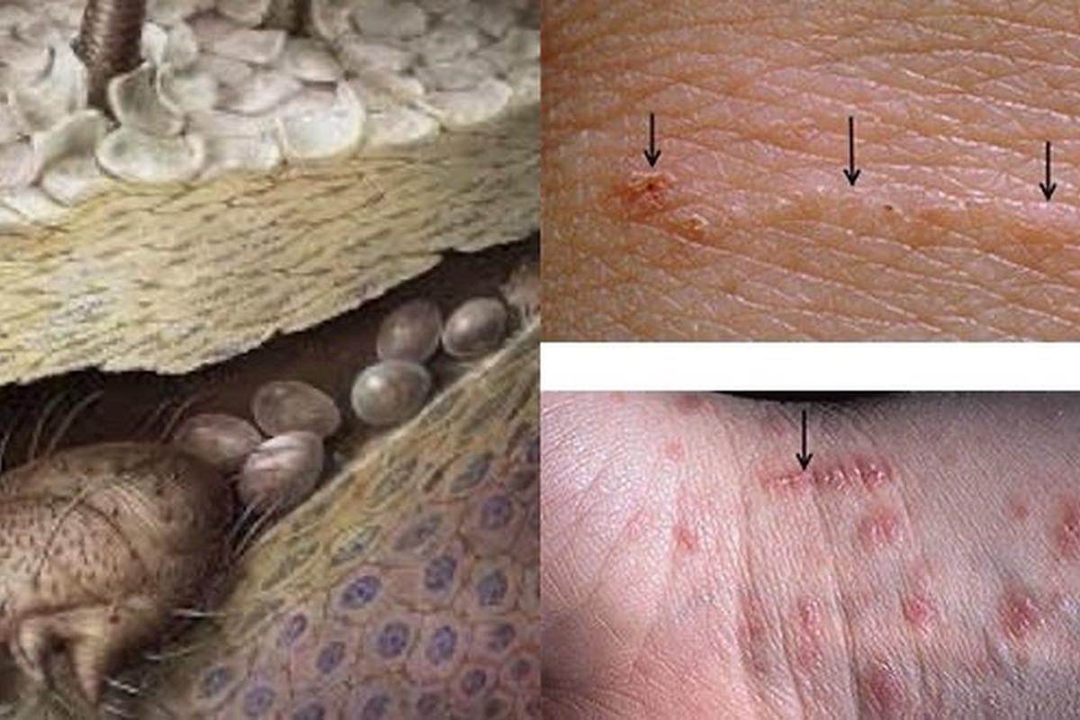 Чесоточный клещ Sarcoptes scabiei и типичные кожные ходы при чесотке
