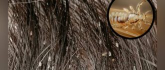 Вши на волосистой части головы — крупный план