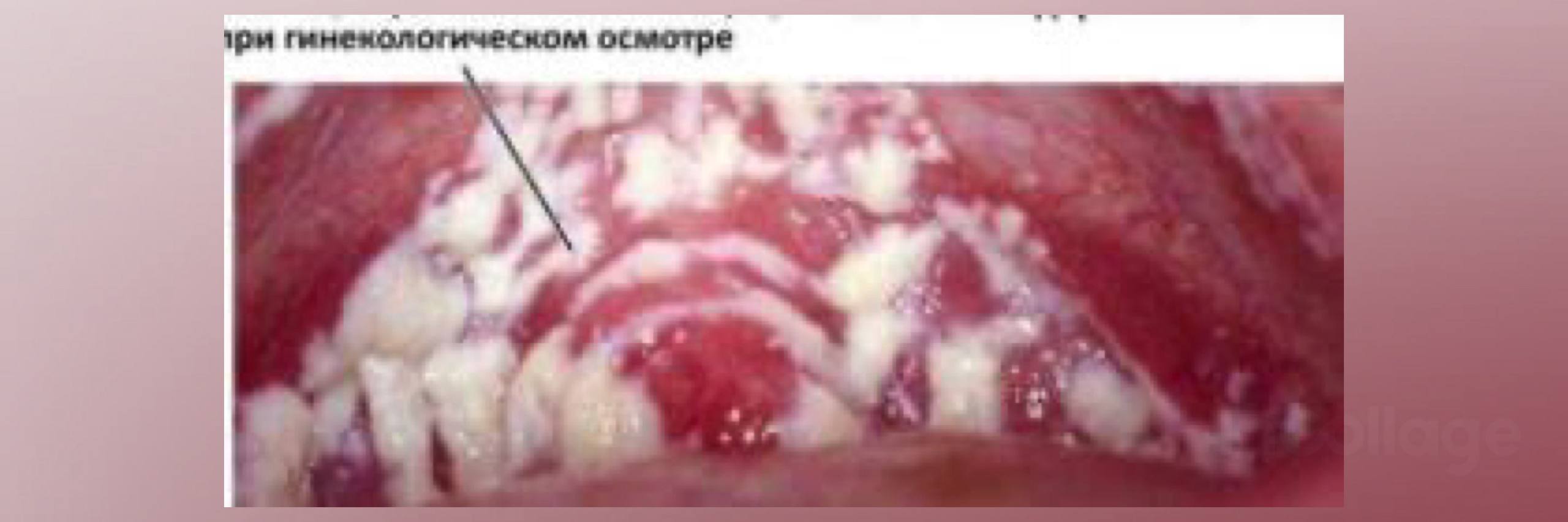 Боль в клиторе при молочнице — симптомы кандидоза