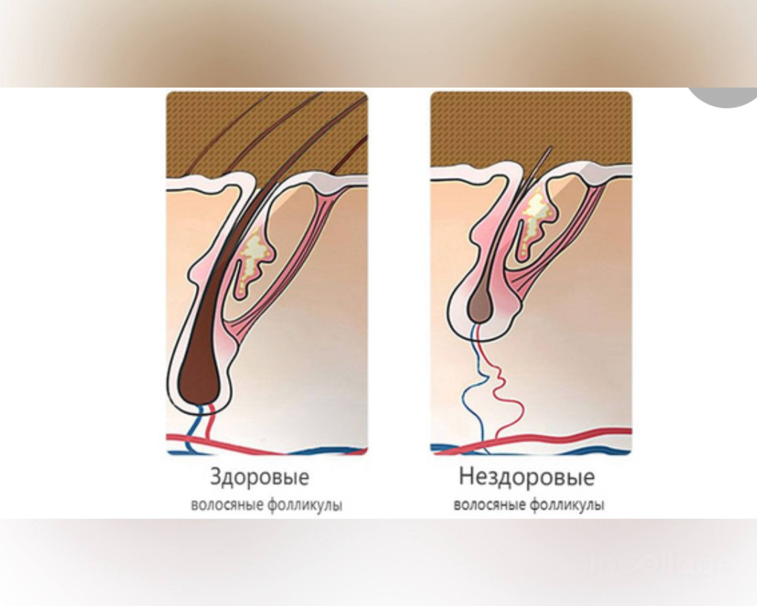 Сравнение здорового и ослабленного волосяного фолликула