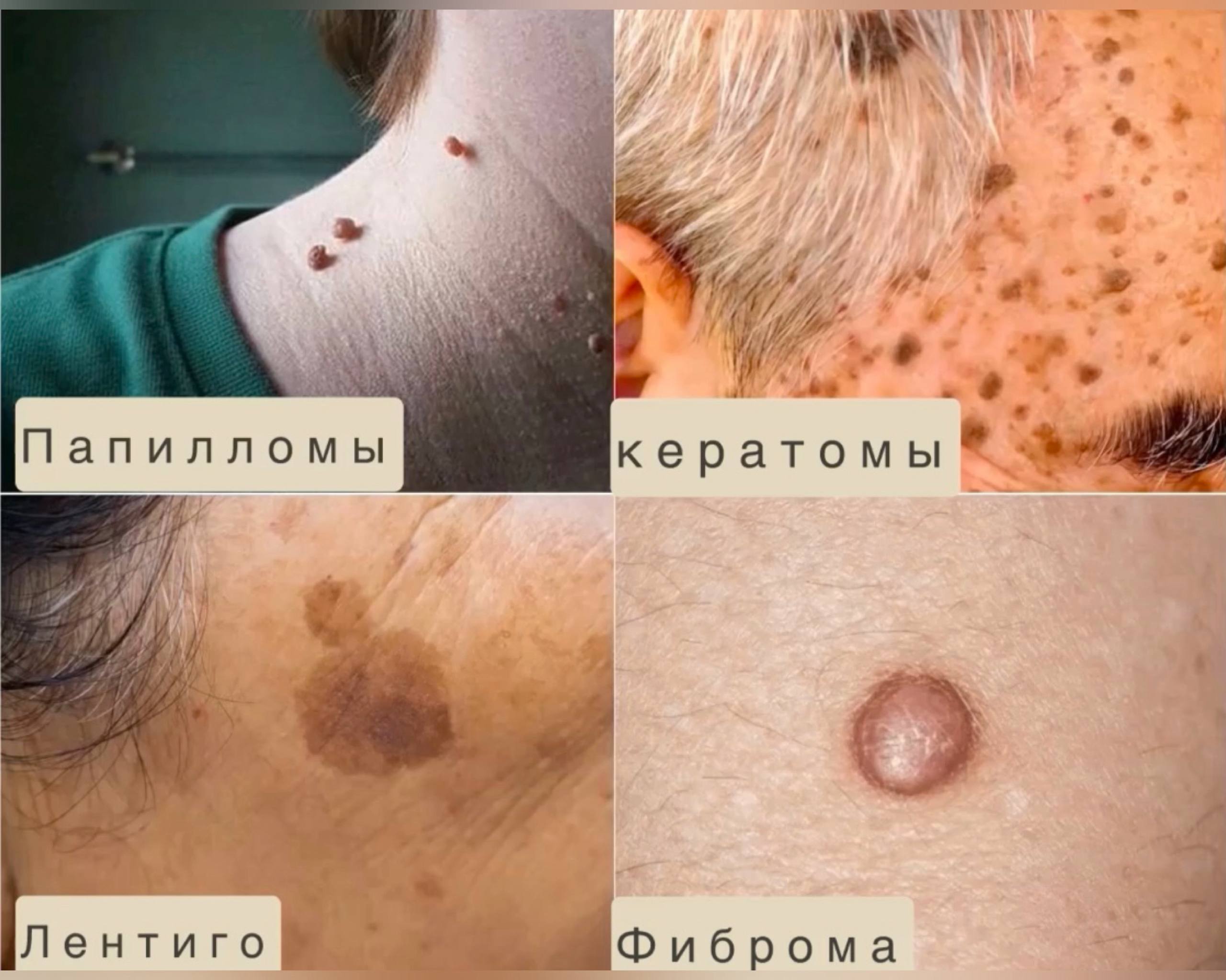  Родинки на коже,различия кожных образований: папилломы, кератомы, лентиго и фиброма