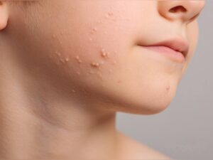 Моллюск контагиозный у ребёнка на коже щеки