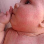Маленький ребёнок с кожными высыпаниями и покраснением на теле.